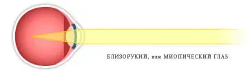 Близорукий глаз: лучи сходятся перед сетчаткой